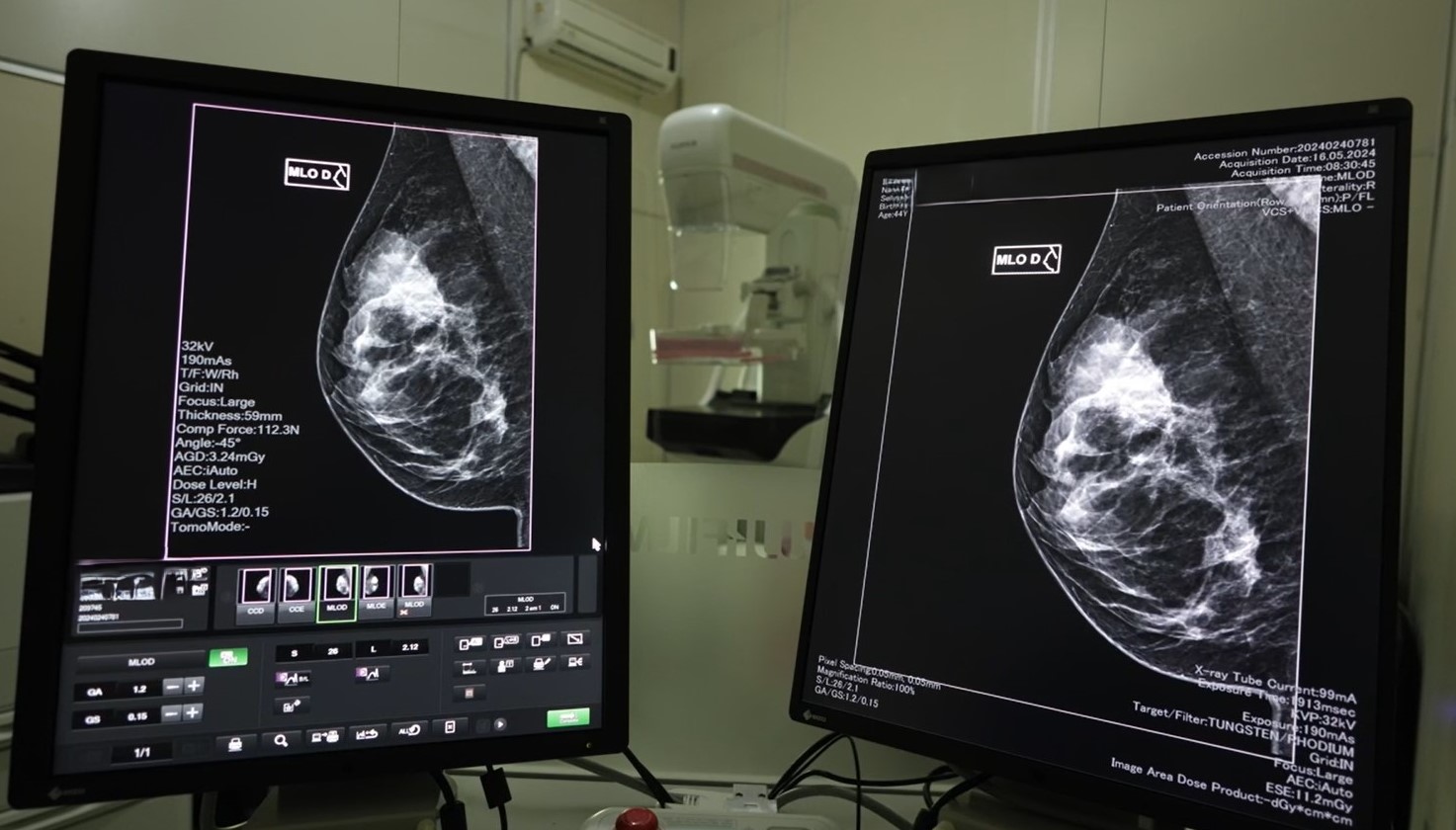 Governo do Estado lança mutirão de mamografias no mês da Mulher 